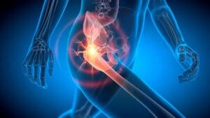 X-ray highlighting hip pain